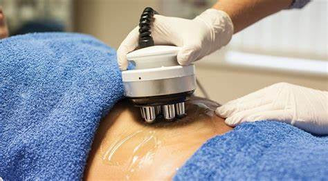 Radio frequency cavitation, NuYu body sculpting, body contouring, cellulite reduction, stretch mark correction, skin tightening, laser Lipo, body slimming, weight loss