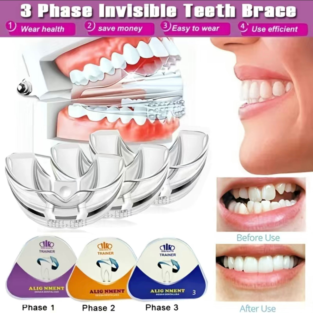 3 Stage Overnight Teeth Aligners - the 3 Phase Night Guard Braces! At home braces. Teeth aligners overnight. Mouth guard. Straighten teeth naturally. Straighten teeth without braces. Veneers. TikTok Viral products. TikTok made me buy it. TikTok famous items 