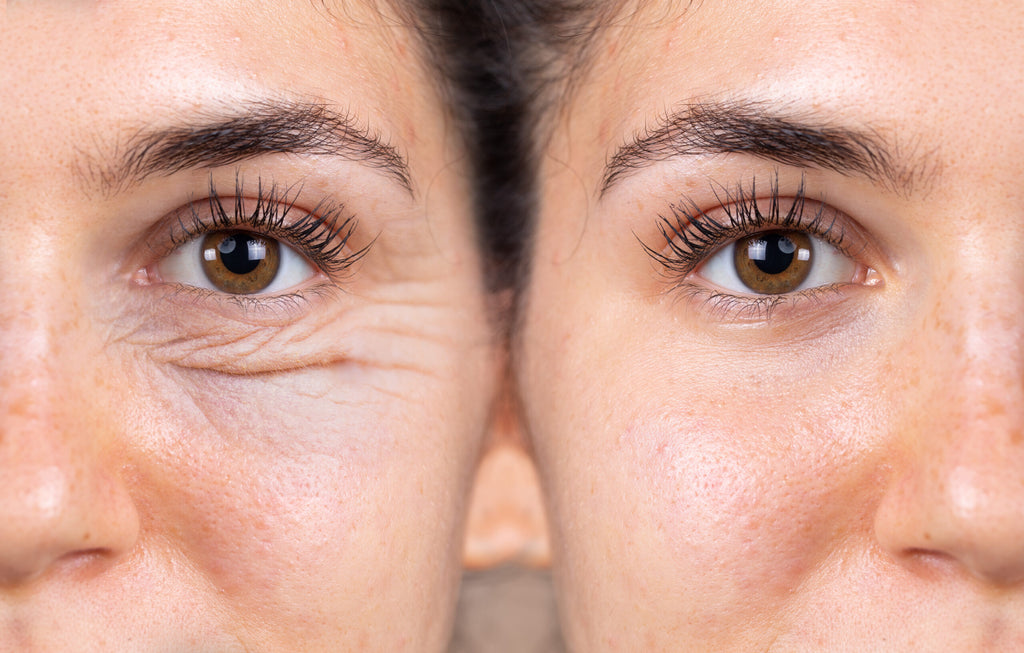 non-surgical under eye treatment, under eye filler, , non-surgical blepharoplasty, under eye rejuvenation, eye bag treatment, dark circle correction, under eye filler treatment, non-invasive eye lift, non-surgical eyelid lift, under eye puffiness treatment, non-surgical cosmetic eye treatment, tear trough filler, under eye hollows correction, under eye filler for bags, no downtime eye lift, under eye wrinkle treatment, non-surgical aesthetic eye procedure, eye rejuvenation non-surgical